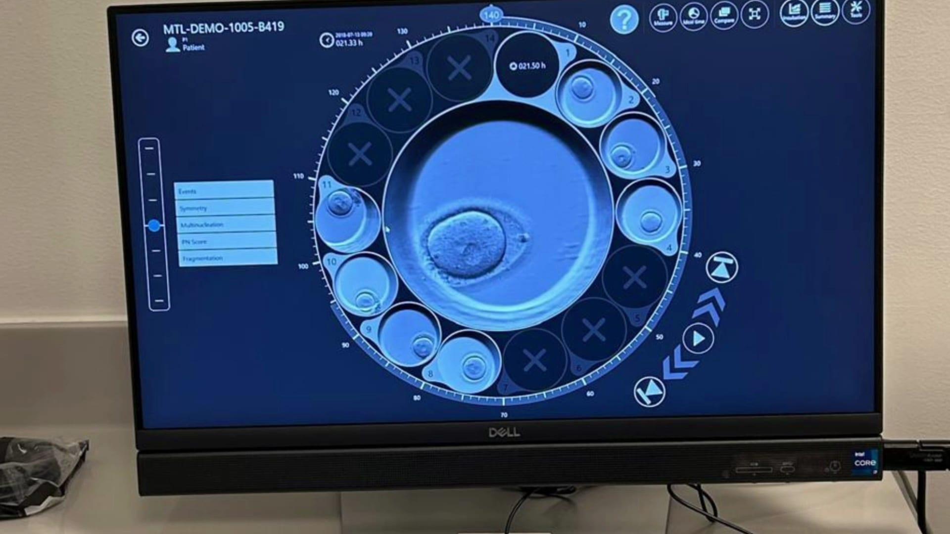 Pantalla de Monitoreo Continuo e Inteligencia Artificial en FIV